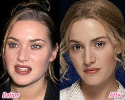 Celebrities πριν και μετά την πλαστική