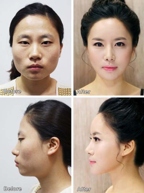 Απίστευτες φωτογραφίες Κορεατών πριν και μετά την πλαστική (10)