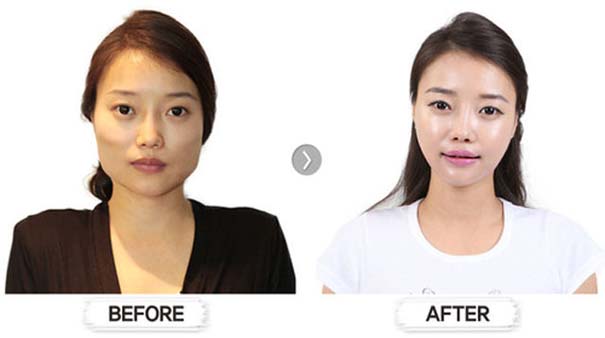 Απίστευτες φωτογραφίες Κορεατών πριν και μετά την πλαστική (12)