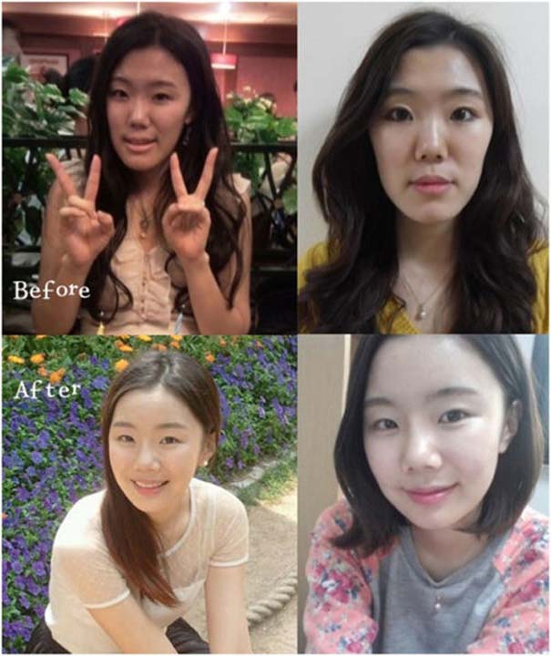 Απίστευτες φωτογραφίες Κορεατών πριν και μετά την πλαστική (13)