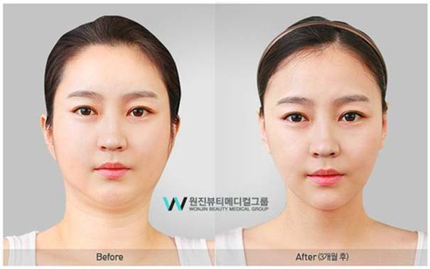 Απίστευτες φωτογραφίες Κορεατών πριν και μετά την πλαστική (14)