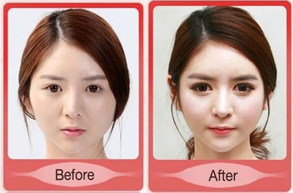 Απίστευτες φωτογραφίες Κορεατών πριν και μετά την πλαστική (19)