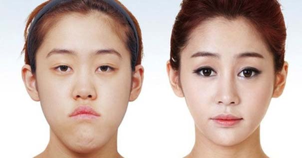 Απίστευτες φωτογραφίες Κορεατών πριν και μετά την πλαστική (20)