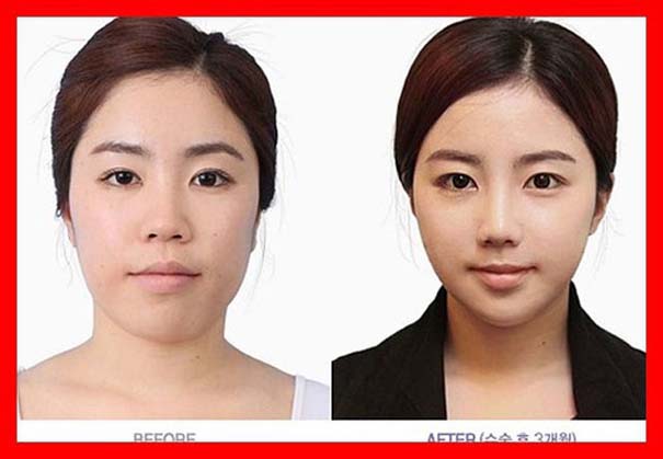 Απίστευτες φωτογραφίες Κορεατών πριν και μετά την πλαστική (23)