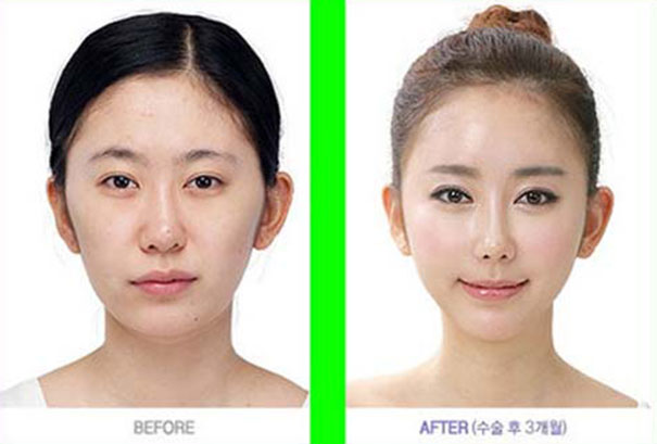 Απίστευτες φωτογραφίες Κορεατών πριν και μετά την πλαστική (25)