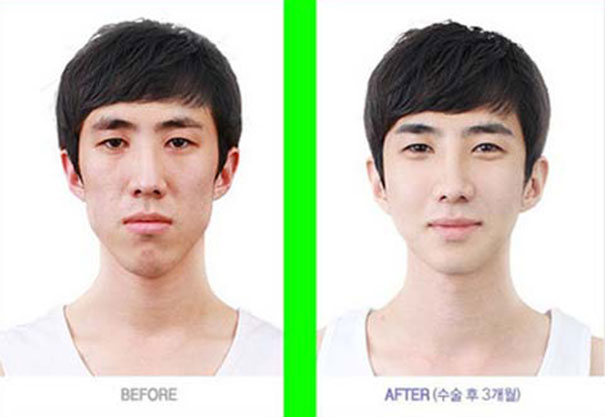 Απίστευτες φωτογραφίες Κορεατών πριν και μετά την πλαστική (26)