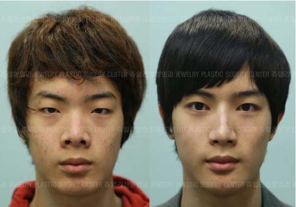 Απίστευτες φωτογραφίες Κορεατών πριν και μετά την πλαστική (31)