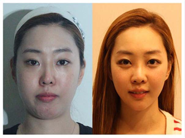 Απίστευτες φωτογραφίες Κορεατών πριν και μετά την πλαστική (32)