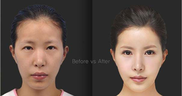 Απίστευτες φωτογραφίες Κορεατών πριν και μετά την πλαστική (33)