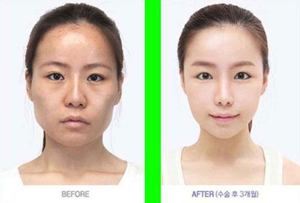 Απίστευτες φωτογραφίες Κορεατών πριν και μετά την πλαστική (35)