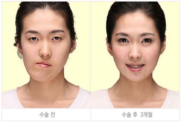 Απίστευτες φωτογραφίες Κορεατών πριν και μετά την πλαστική (36)