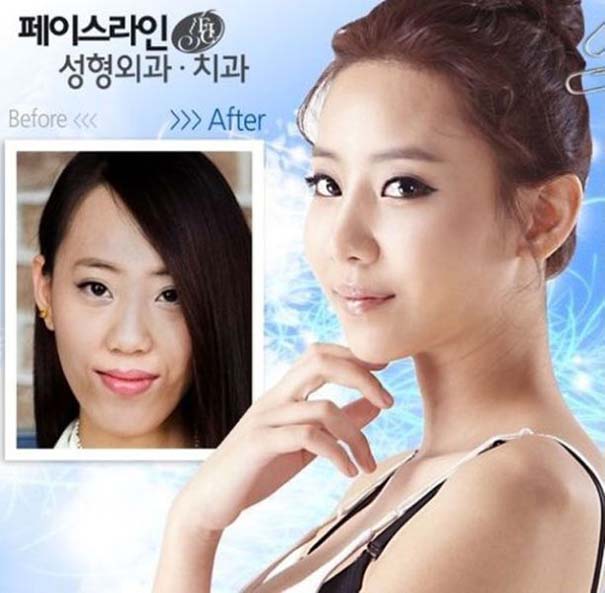 Απίστευτες φωτογραφίες Κορεατών πριν και μετά την πλαστική (38)