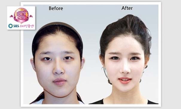 Απίστευτες φωτογραφίες Κορεατών πριν και μετά την πλαστική (39)