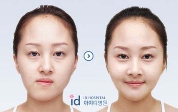 Απίστευτες φωτογραφίες Κορεατών πριν και μετά την πλαστική (40)