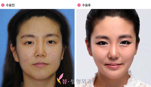 Απίστευτες φωτογραφίες Κορεατών πριν και μετά την πλαστική (41)