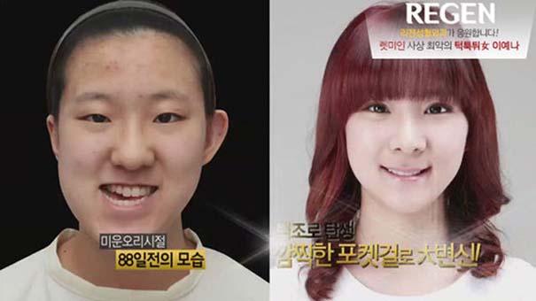 Απίστευτες φωτογραφίες Κορεατών πριν και μετά την πλαστική (42)