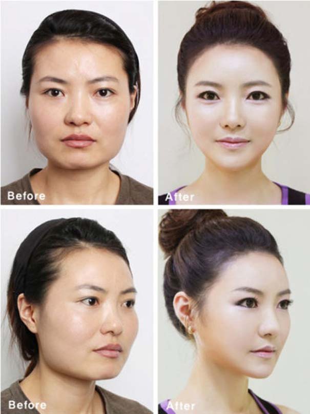 Απίστευτες φωτογραφίες Κορεατών πριν και μετά την πλαστική (43)