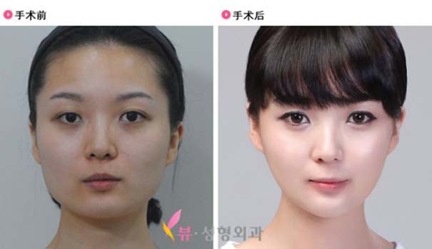 Απίστευτες φωτογραφίες Κορεατών πριν και μετά την πλαστική (45)