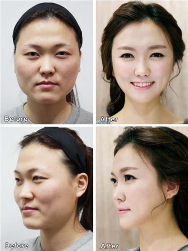 Απίστευτες φωτογραφίες Κορεατών πριν και μετά την πλαστική (46)