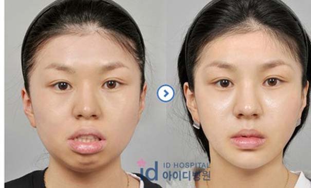 Απίστευτες φωτογραφίες Κορεατών πριν και μετά την πλαστική (47)