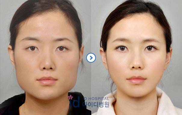 Απίστευτες φωτογραφίες Κορεατών πριν και μετά την πλαστική (3)
