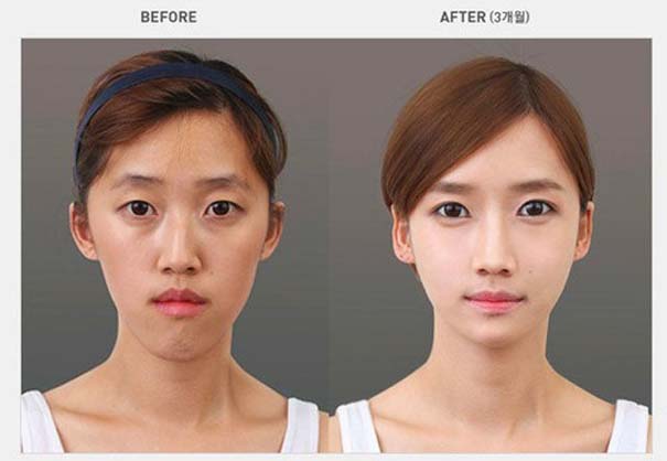 Απίστευτες φωτογραφίες Κορεατών πριν και μετά την πλαστική (4)