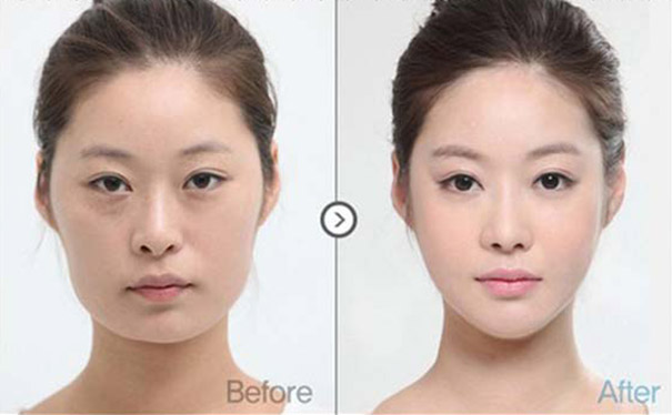 Απίστευτες φωτογραφίες Κορεατών πριν και μετά την πλαστική (6)