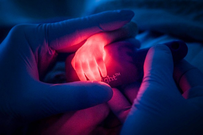 Νοσοκόμα ψάχνει για φλέβα στο χέρι πρόωρου νεογέννητου | Φωτογραφία της ημέρας