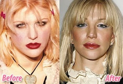 Celebrities πριν και μετά την πλαστική