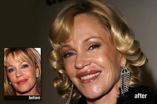 Celebrities πριν και μετά την πλαστική (2)