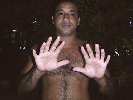 Κουβανός με 24 δάχτυλα (1)