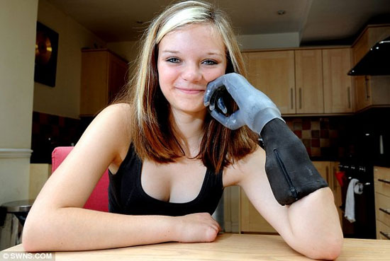 15χρονη απέκτησε βιονικά δάχτυλα (1)