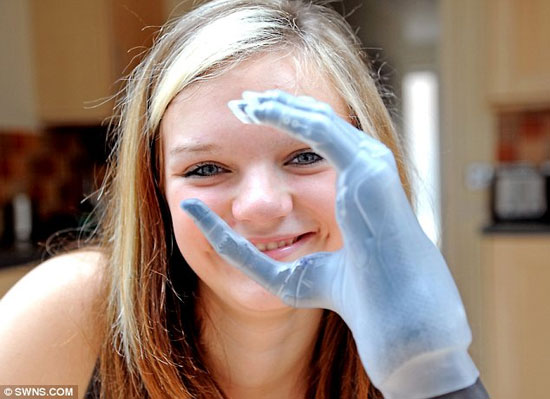 15χρονη απέκτησε βιονικά δάχτυλα (2)