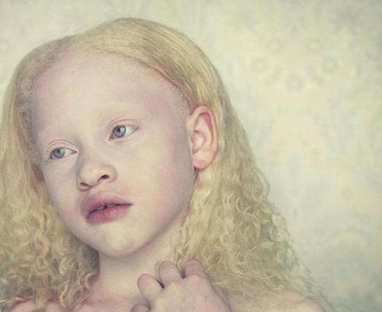 Albino (14)