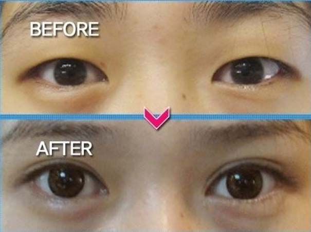 Απίστευτες φωτογραφίες Κορεατών πριν και μετά την πλαστική (1)