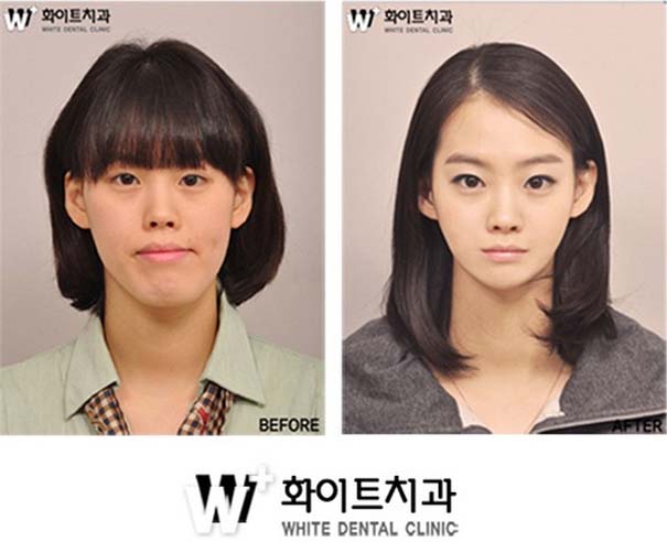 Απίστευτες φωτογραφίες Κορεατών πριν και μετά την πλαστική (11)