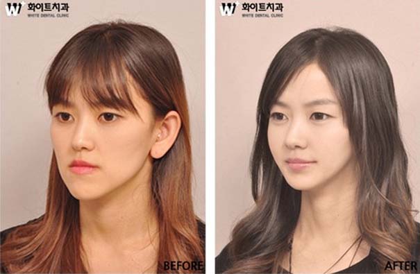 Απίστευτες φωτογραφίες Κορεατών πριν και μετά την πλαστική (17)