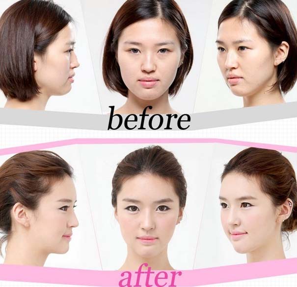 Απίστευτες φωτογραφίες Κορεατών πριν και μετά την πλαστική (28)
