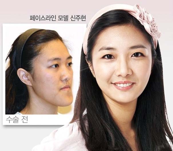 Απίστευτες φωτογραφίες Κορεατών πριν και μετά την πλαστική (30)