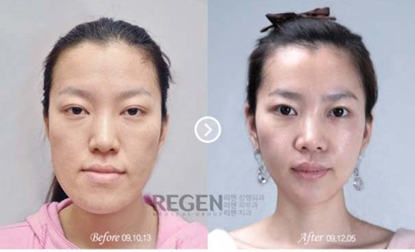 Απίστευτες φωτογραφίες Κορεατών πριν και μετά την πλαστική (15)