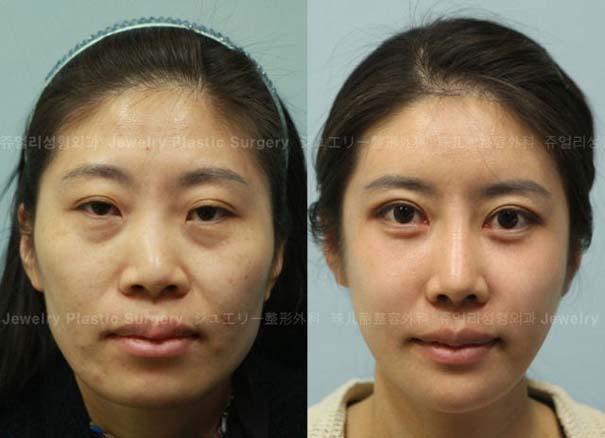 Απίστευτες φωτογραφίες Κορεατών πριν και μετά την πλαστική (16)