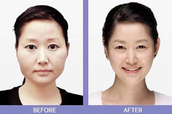 Απίστευτες φωτογραφίες Κορεατών πριν και μετά την πλαστική (7)