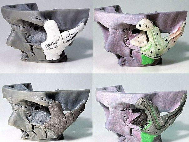 3D εκτύπωση κρανίου για θύμα τροχαίου με μοτοσυκλέτα (2)