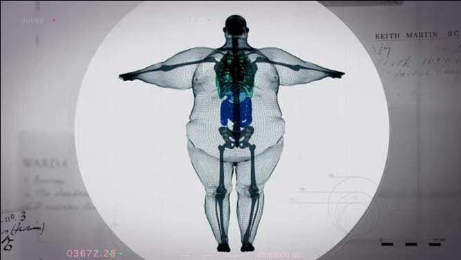 Ακτινογραφίες ανθρώπου 445 κιλών (4)