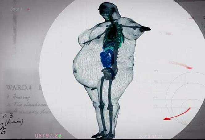 Ακτινογραφίες ανθρώπου 445 κιλών (5)