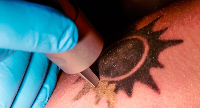 Πως λειτουργεί η τεχνική της αφαίρεσης τατουάζ με λέιζερ