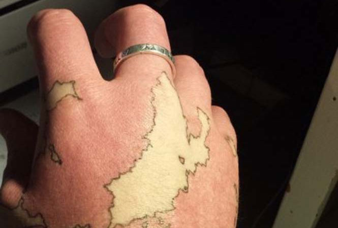 Άνδρας μετέτρεψε το εκ γενετής σημάδι του σε χάρτη ενός φανταστικού κόσμου