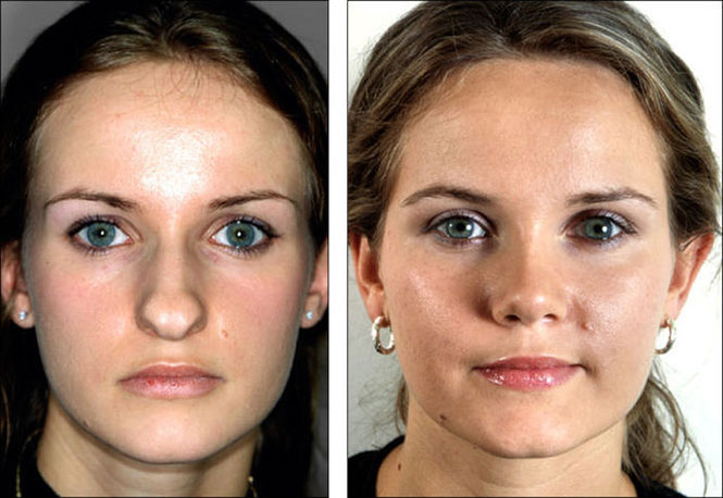 Φωτογραφίες πριν και μετά την πλαστική δείχνουν πως η μύτη μπορεί να αλλάξει τελείως ένα πρόσωπο (7)