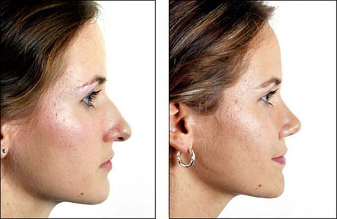 Φωτογραφίες πριν και μετά την πλαστική δείχνουν πως η μύτη μπορεί να αλλάξει τελείως ένα πρόσωπο (9)