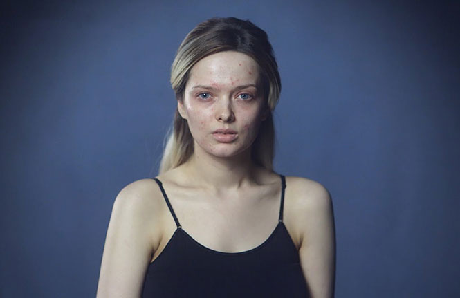 Γυναίκα δείχνει την σκληρή αντιμετώπιση που έχει εξαιτίας της ακμής στο δέρμα της